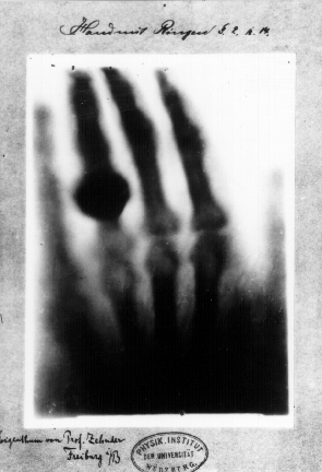 The first medical X-ray, of Anna Bertha Roentgen's hand, 1895