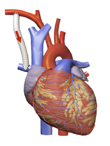 Diagram of the Blalock–Taussig shunt connecting a systemic artery to the pulmonary artery