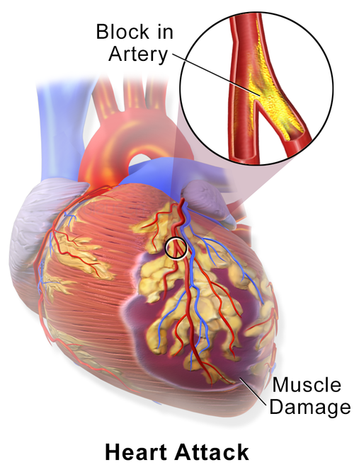 Illustration of a myocardial infarction, the focus of large simple trials such as ISIS