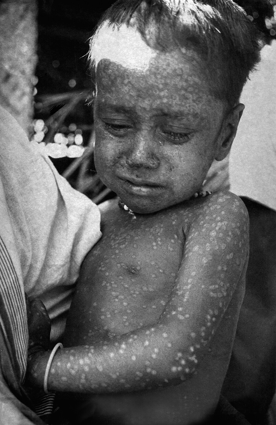 Rahima Banu, the last natural case of major smallpox, 1975