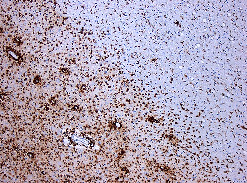 Micrograph showing demyelination characteristic of multiple sclerosis