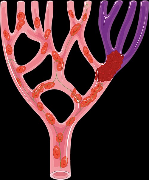 Illustration of a thrombus, the target of alteplase thrombolysis