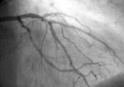 Percutaneous coronary intervention procedure