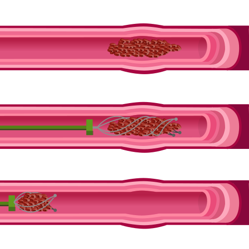 Diagram of an endovascular thrombectomy removing a clot from a blood vessel