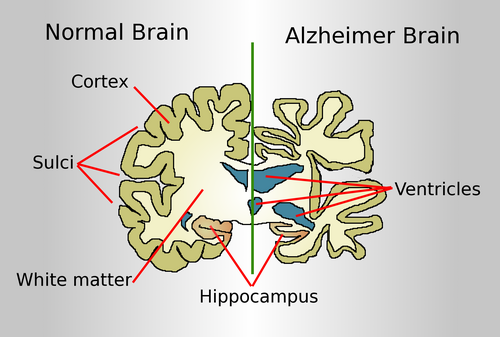 Brain imaging illustrating changes in Alzheimer's disease