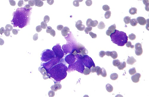 Micrograph of small-cell lung carcinoma, the cancer treated by tarlatamab